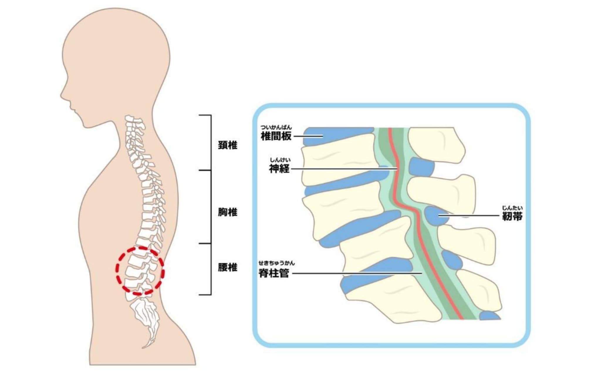 腰部脊柱管狭窄症