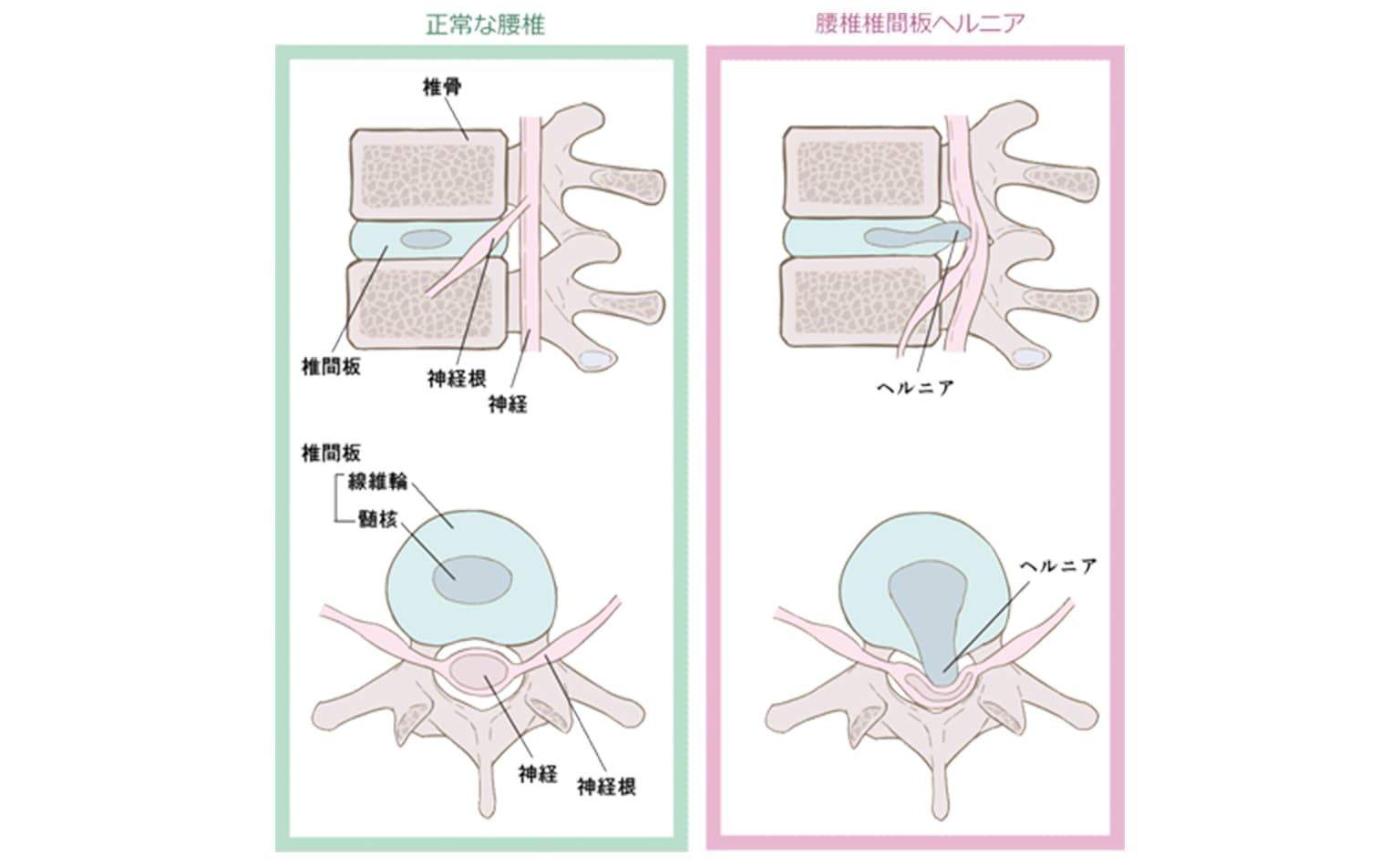 腰椎椎間板ヘルニア