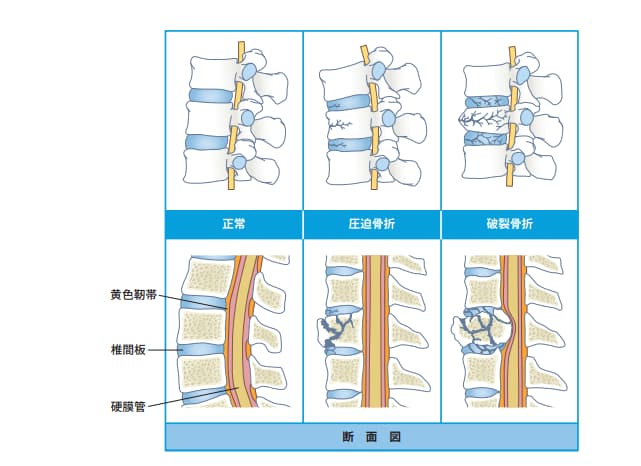 椎体骨折