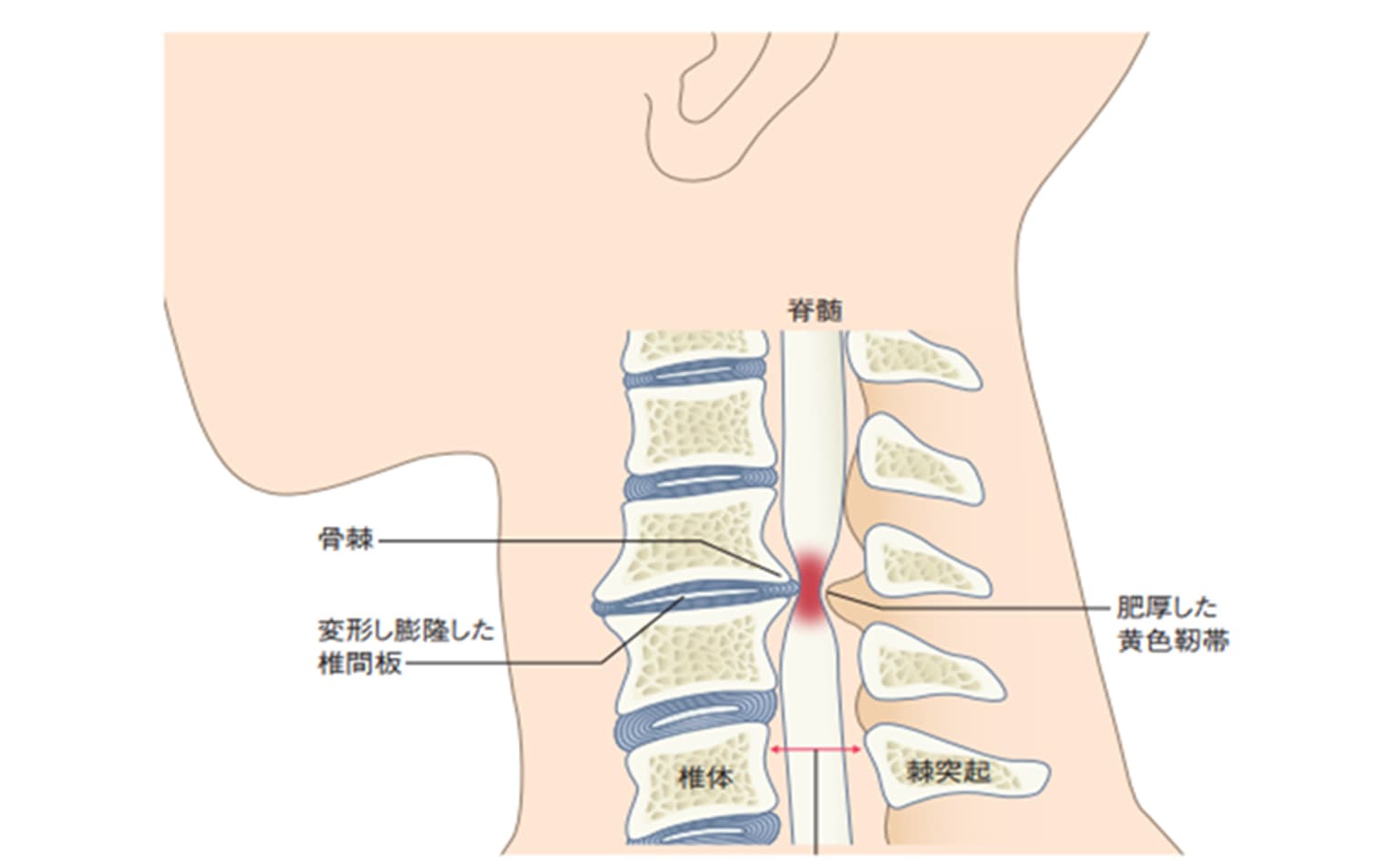 頸椎症性脊髄症