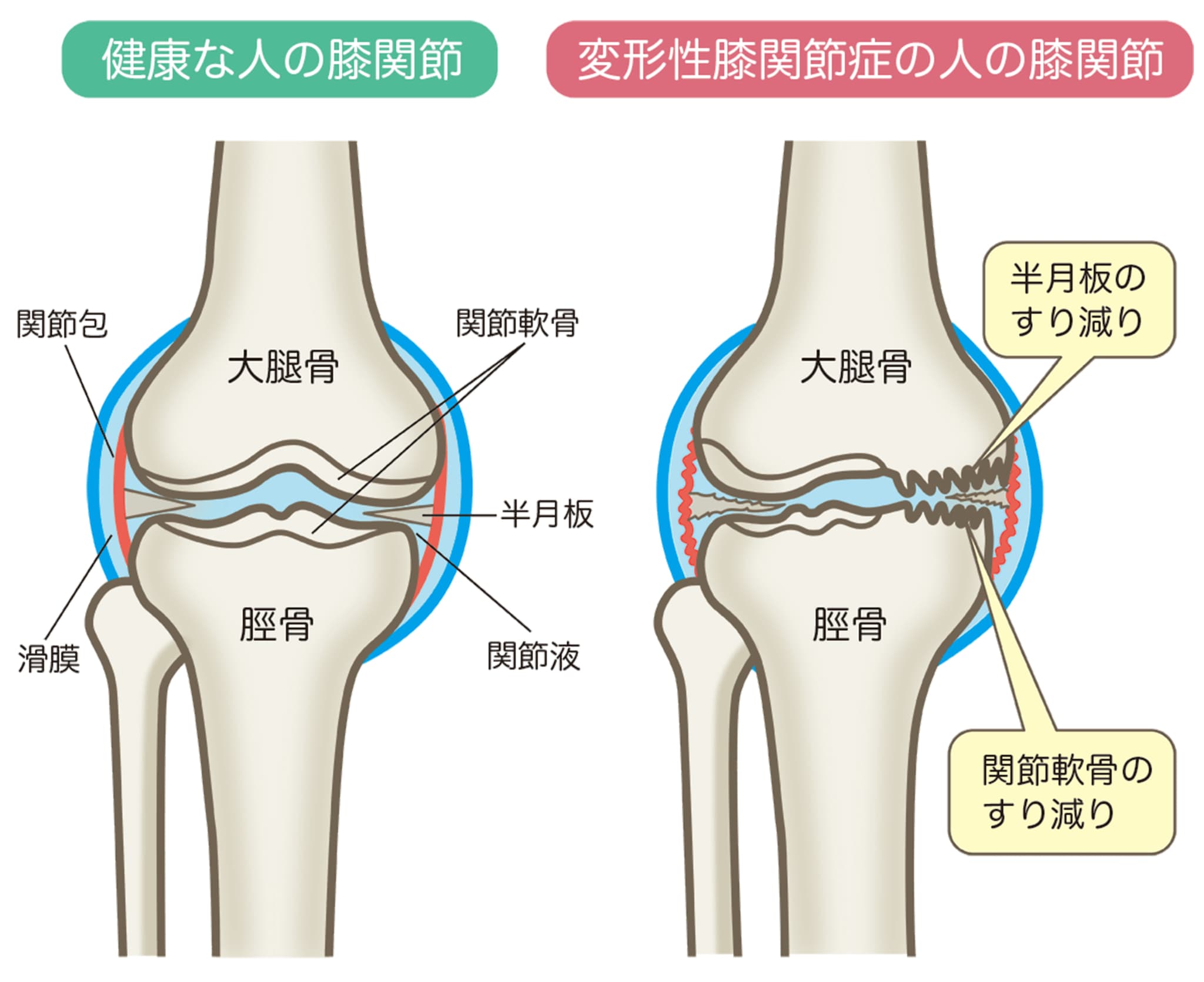 変形性膝関節症